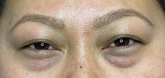 Close-up of a person's eyes with visible under-eye dark circles and puffy eyelids