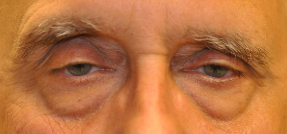 Close-up of a person’s tired eyes and upper face against a blurred background