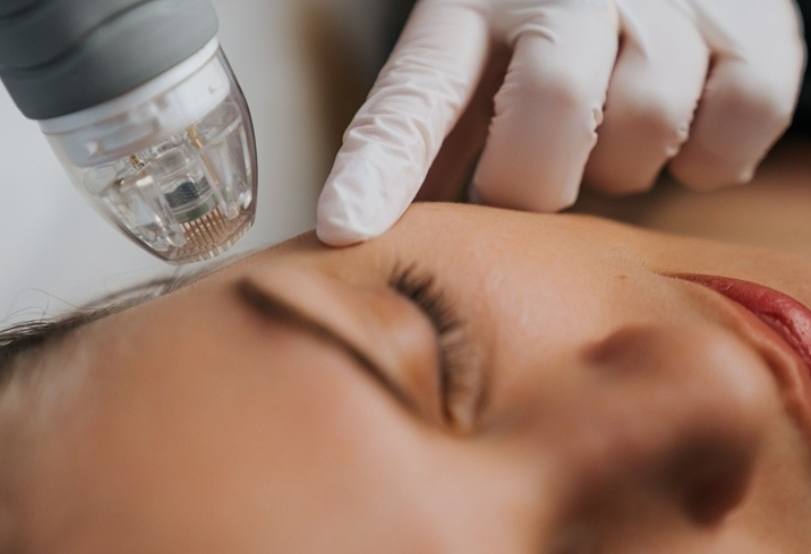 Morpheus8 microneedling fractional treatment