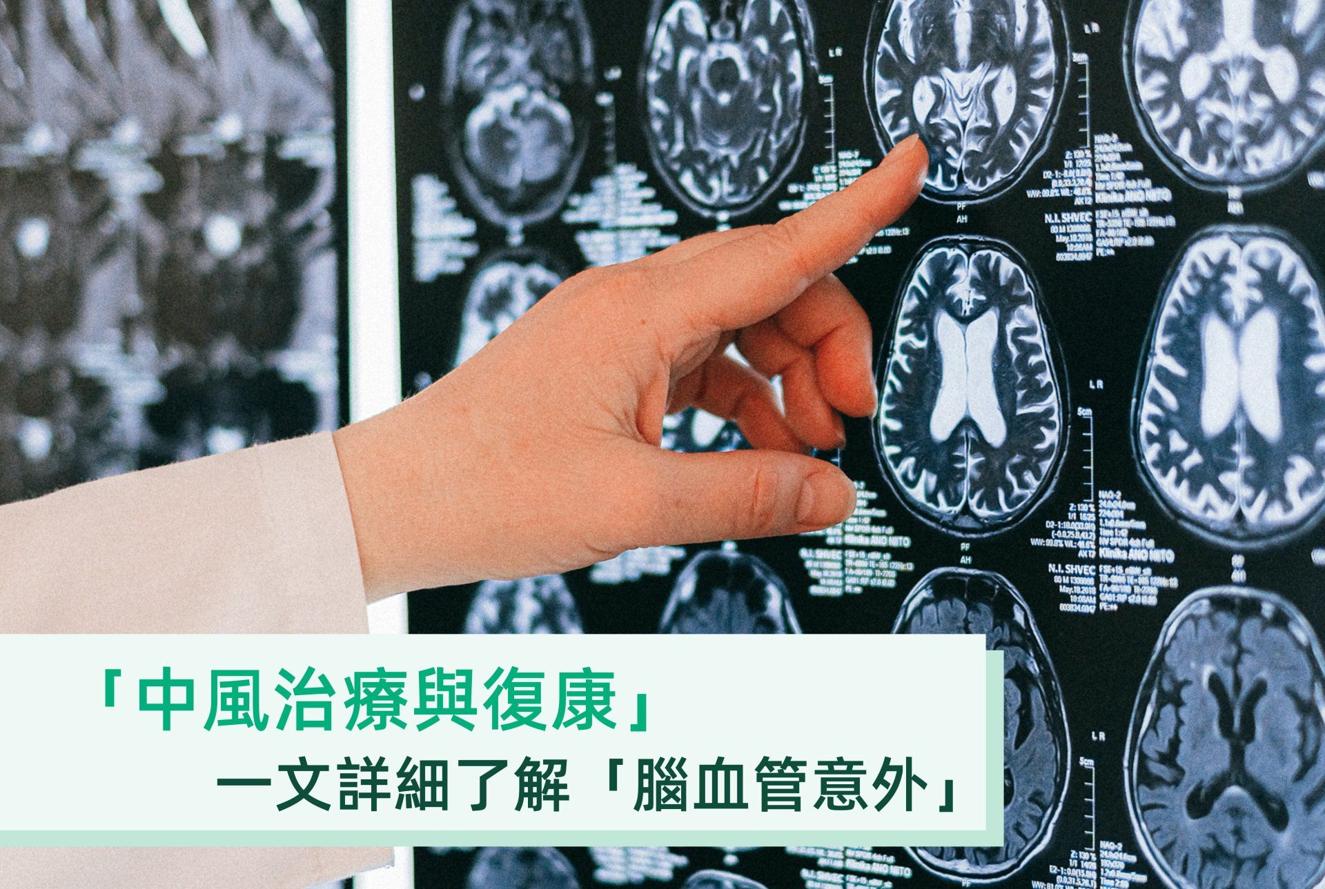 【中風】一文詳細了解「腦血管意外」