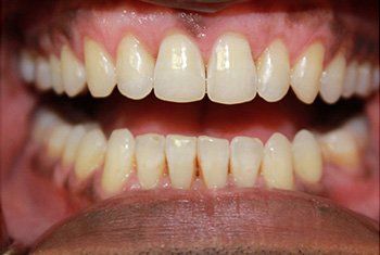 teeth after invisalign