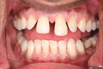 teeth before invisalign