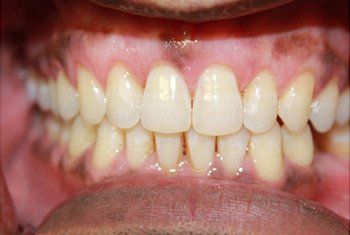 teeth after invisalign