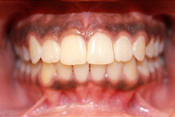 teeth after invisalign 2