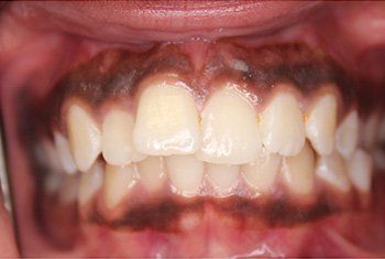 teeth before invisalign 2