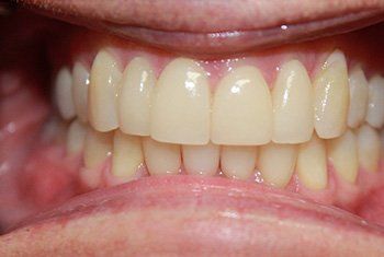 teeth after invisalign