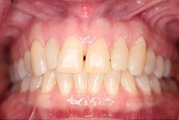 teeth before invisalign
