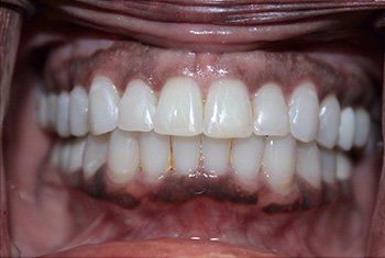 teeth after invisalign