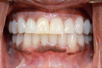 teeth before invisalign