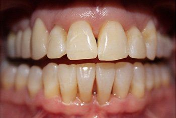 after invisalign 2