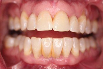 before invisalign 2