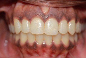 teeth after invisalign 2