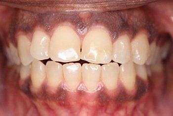 teeth before invisalign 2