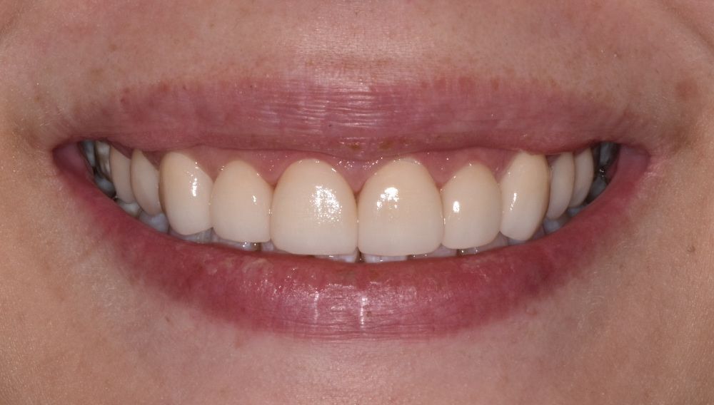 after invisalign