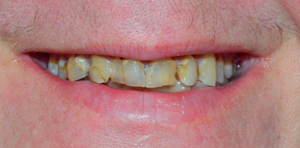before invisalign 2
