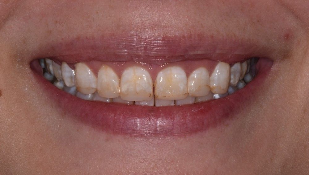 before invisalign