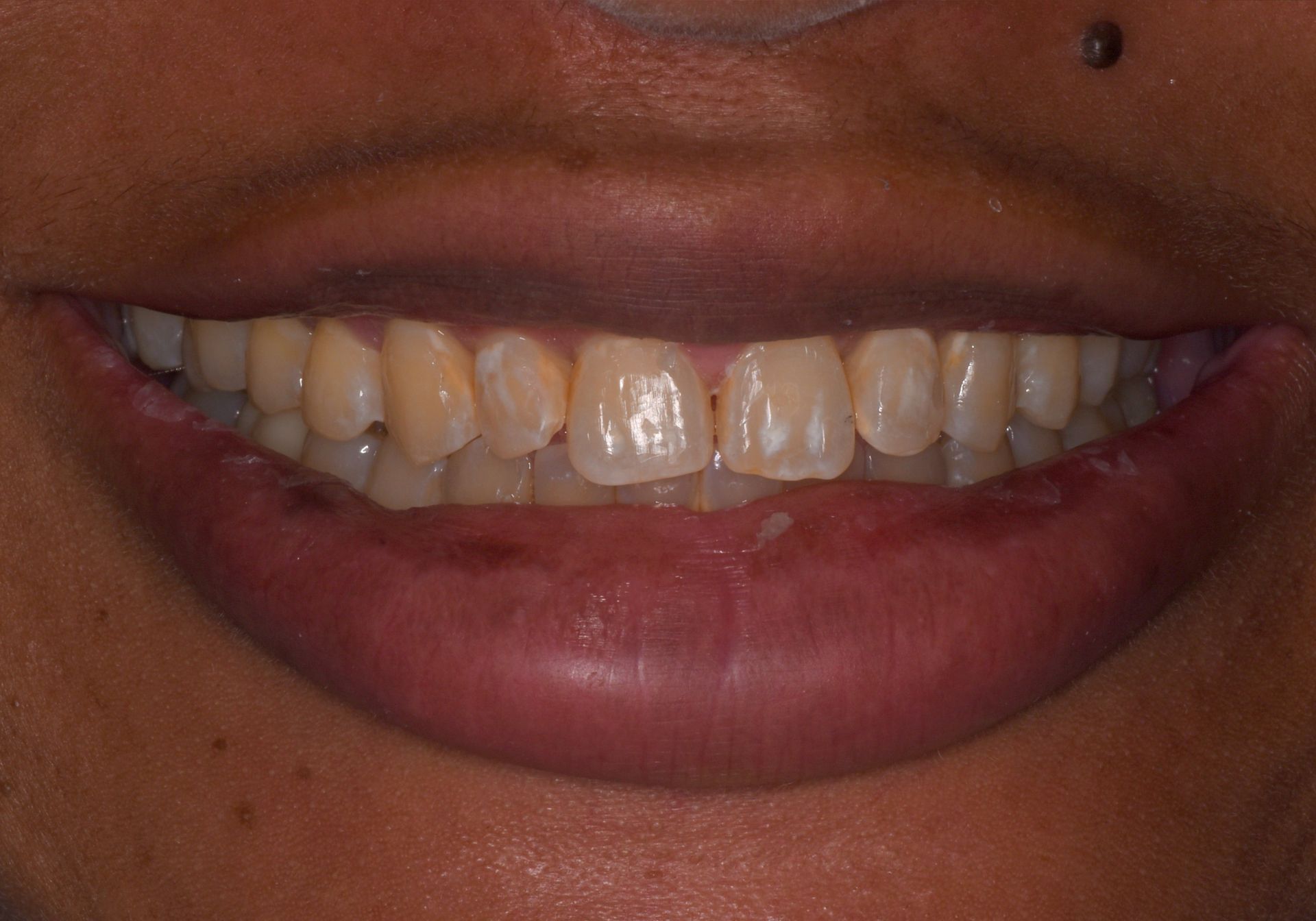 after invisalign