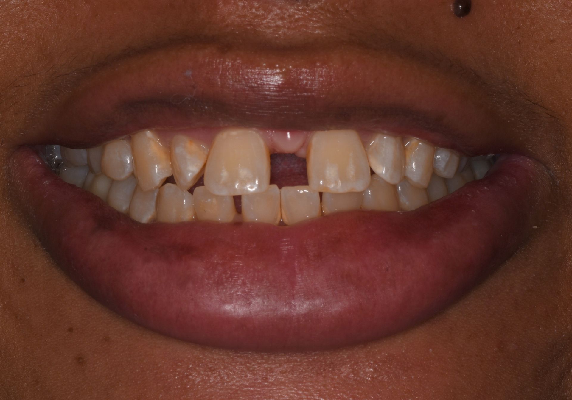 before invisalign