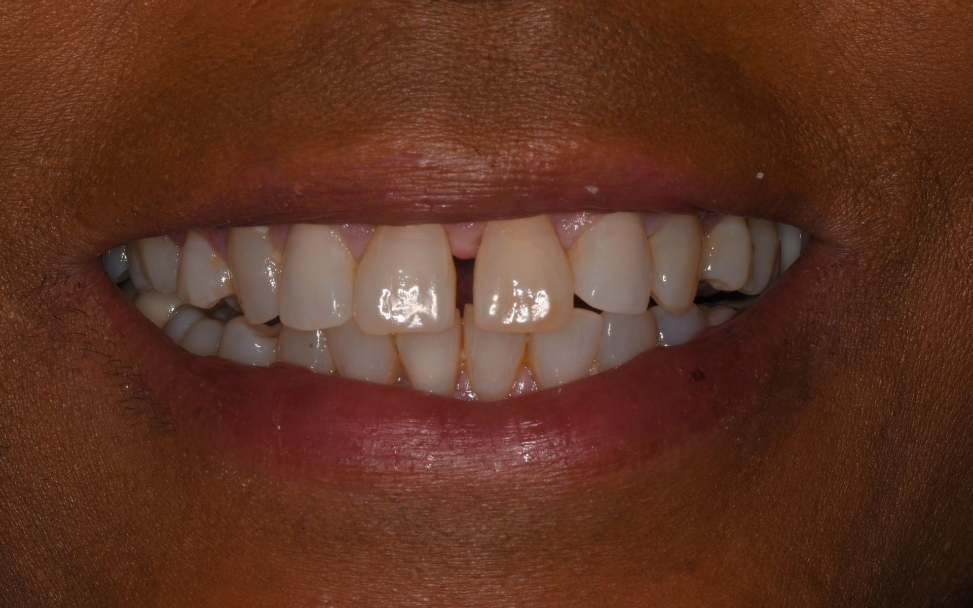 before invisalign 2