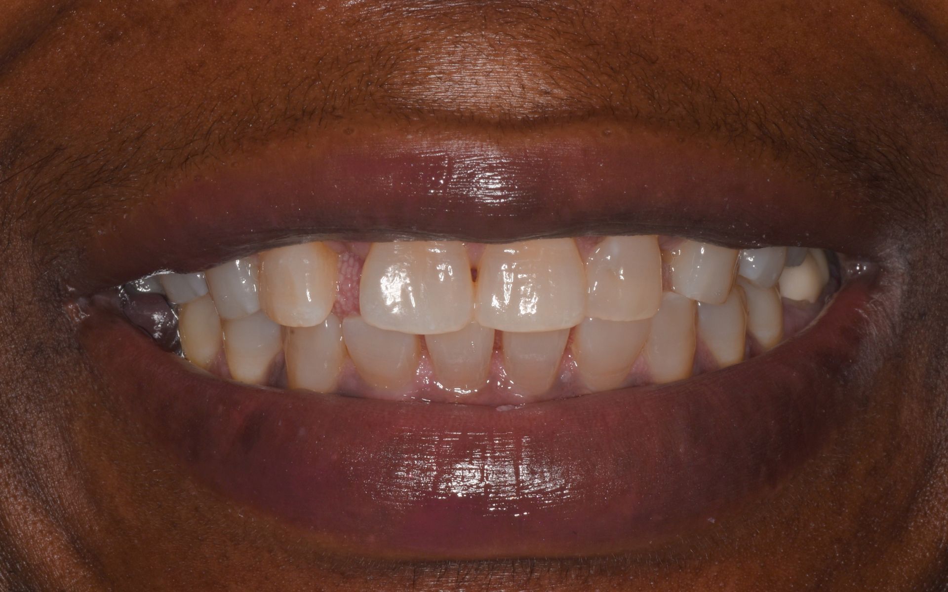 before invisalign 2