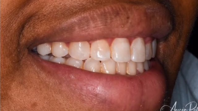 Close-up of a smiling mouth with white teeth and pink gums.