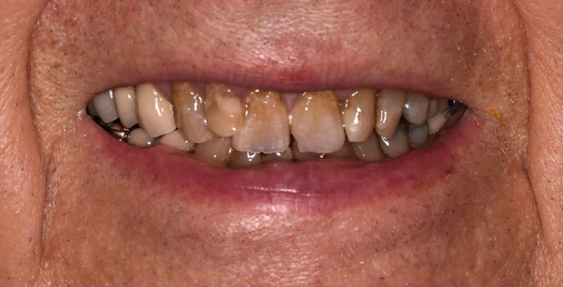 Close-up of a smiling mouth with yellowed, uneven teeth