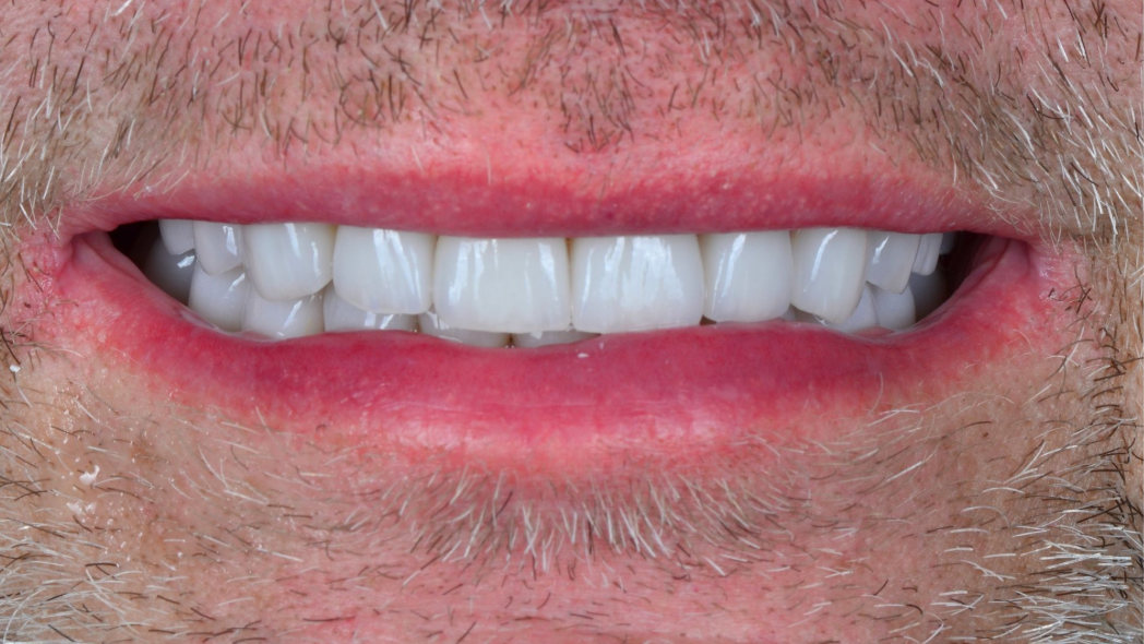 Close-up of a smiling mouth with white teeth and light facial stubble