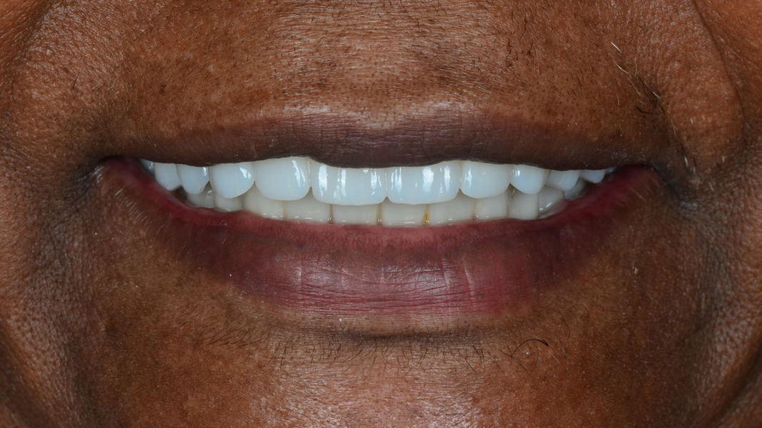 Close-up of a smiling mouth showing white teeth and pink lips.