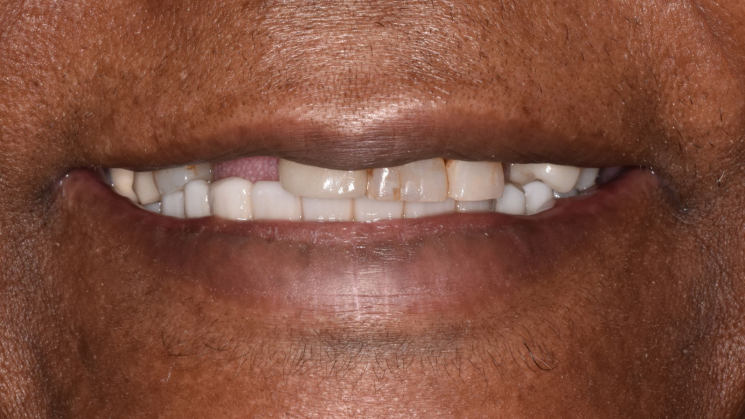 Close-up of a smiling mouth showing white teeth and a gold tooth