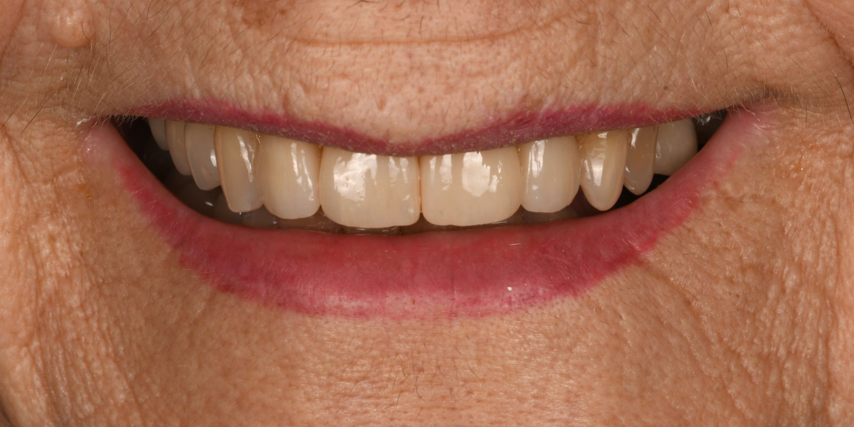 Smile Savers Dentistry Columbia MD Crowns After
