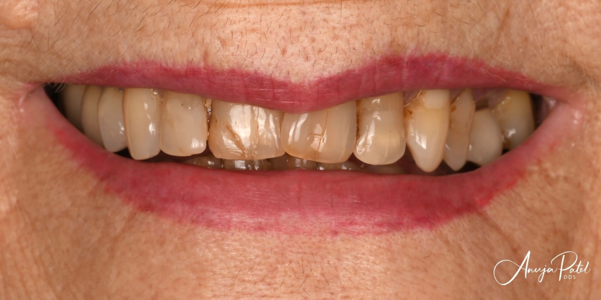 Smile Savers Dentistry Columbia MD Crowns Before
