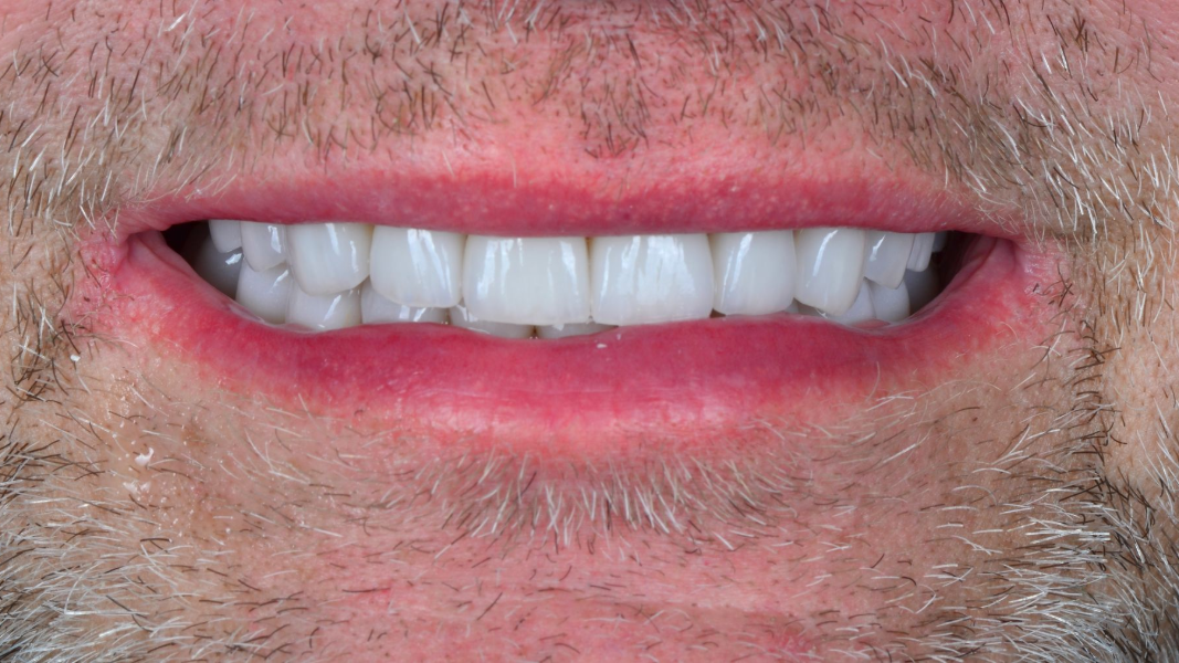 Close-up of a smiling mouth with white teeth and light facial stubble