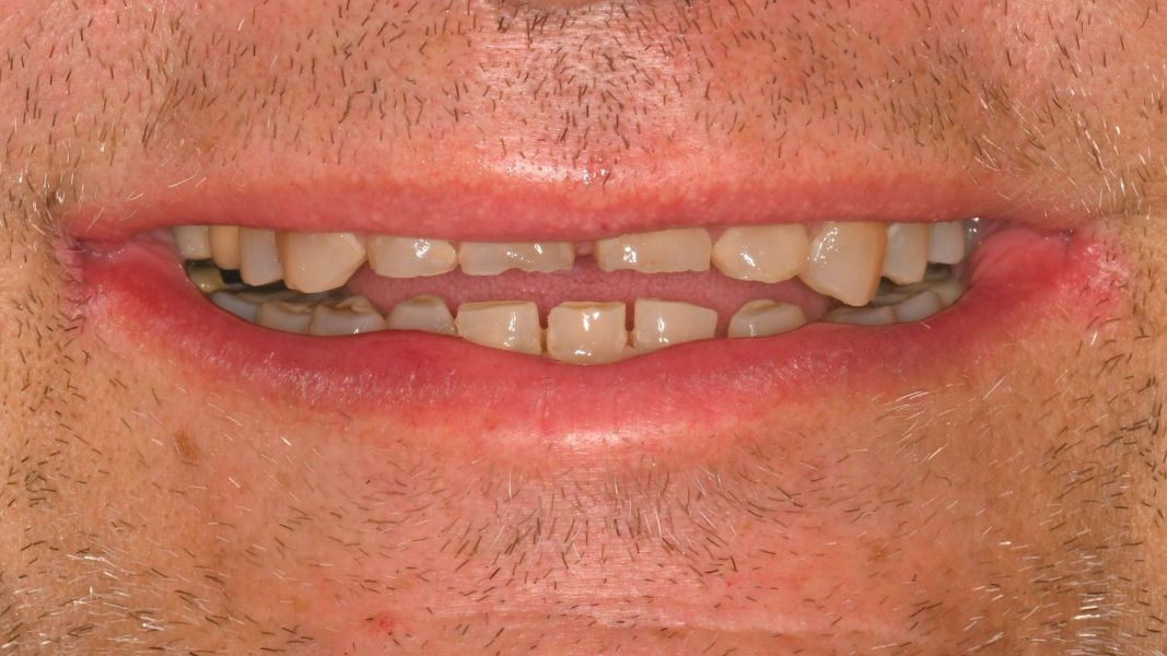 Close-up of a smiling mouth with missing and crooked teeth and light facial stubble