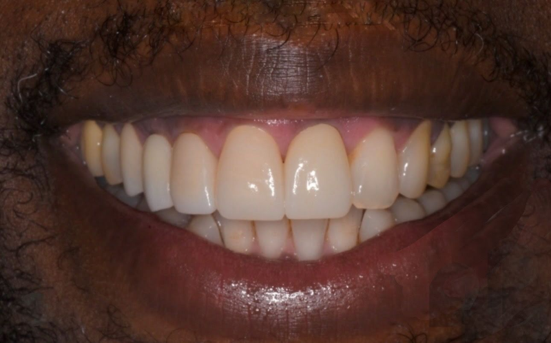 Close-up of a smiling mouth showing white teeth and dark lips.