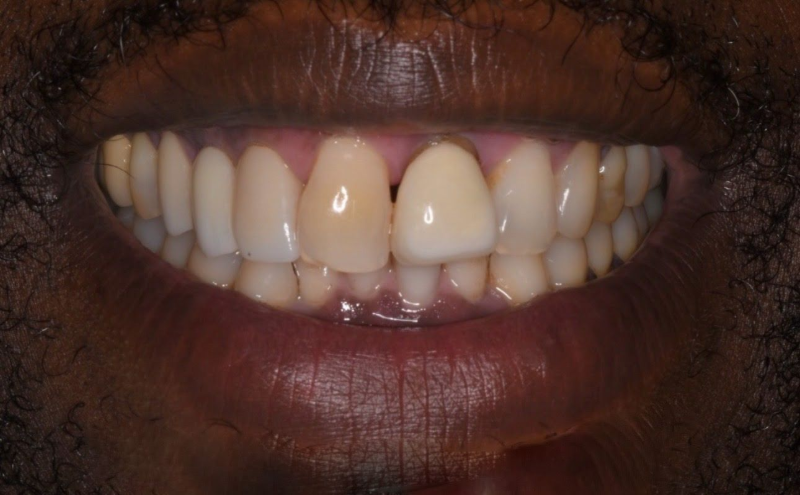 Close-up of a smiling mouth showing teeth with a noticeable gap between the front teeth.