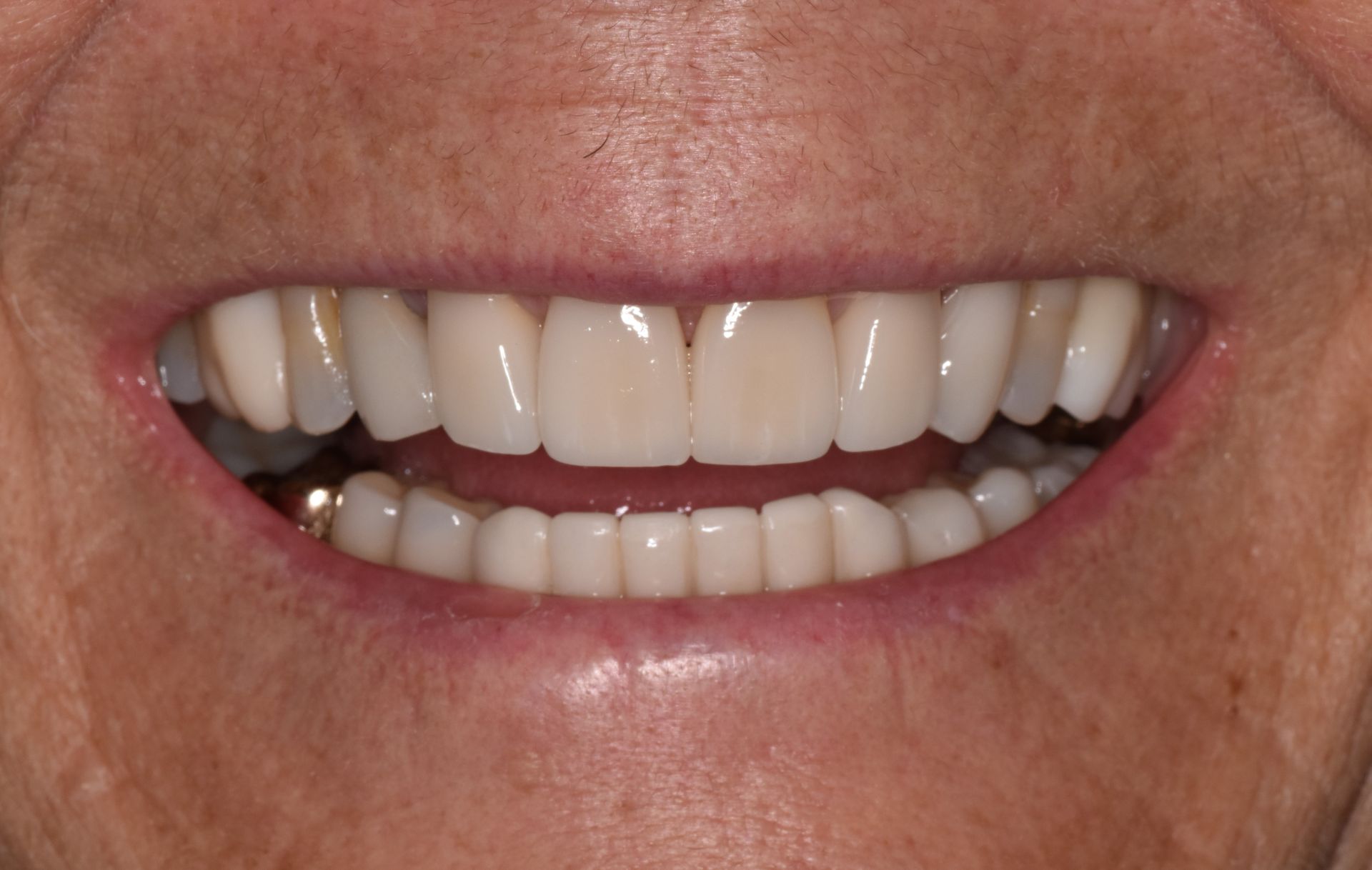 Close-up of a smiling mouth with white teeth and pink lips