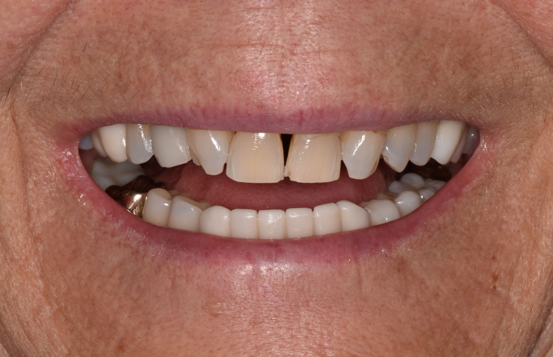 Close-up of a smiling mouth with visible teeth, including one missing front tooth.