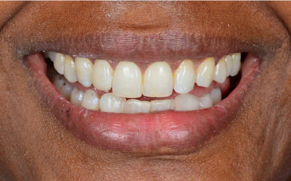 Close-up of a smiling mouth showing teeth, with a front tooth slightly out of alignment.