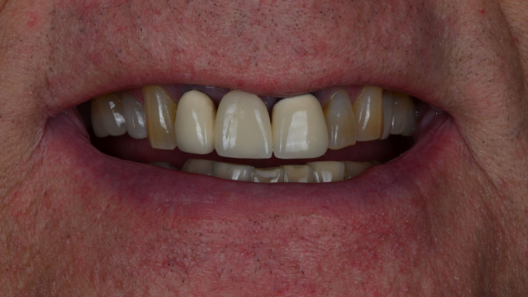 Close-up of a person’s mouth with partially visible teeth and lips in a slight smile
