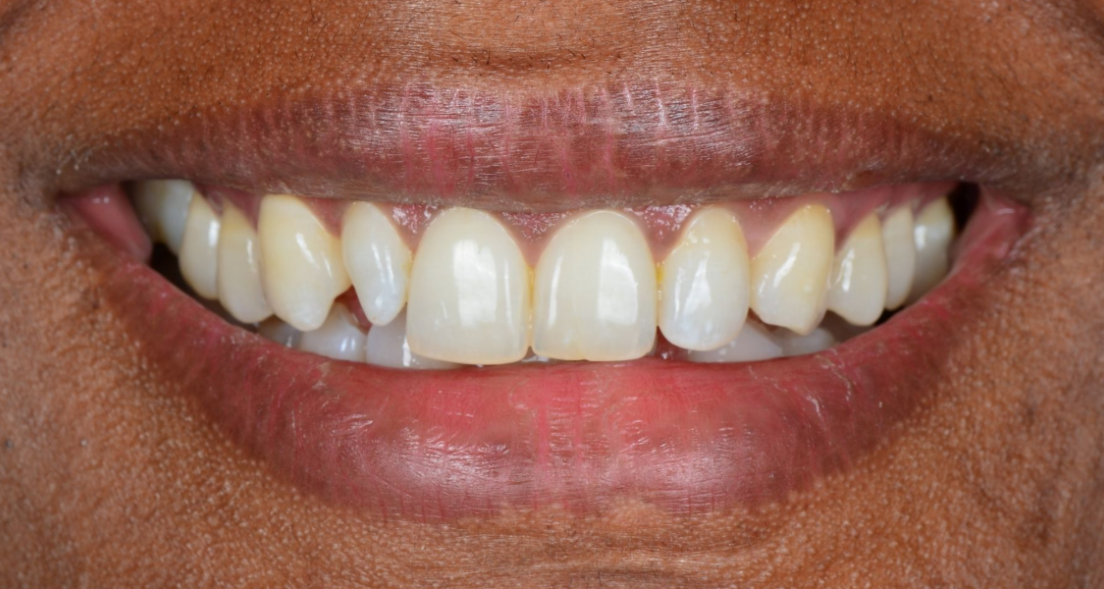 Close-up of a smiling mouth showing white teeth
