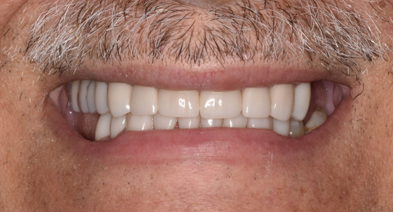 Close-up of a smiling mouth with white teeth and a mustache
