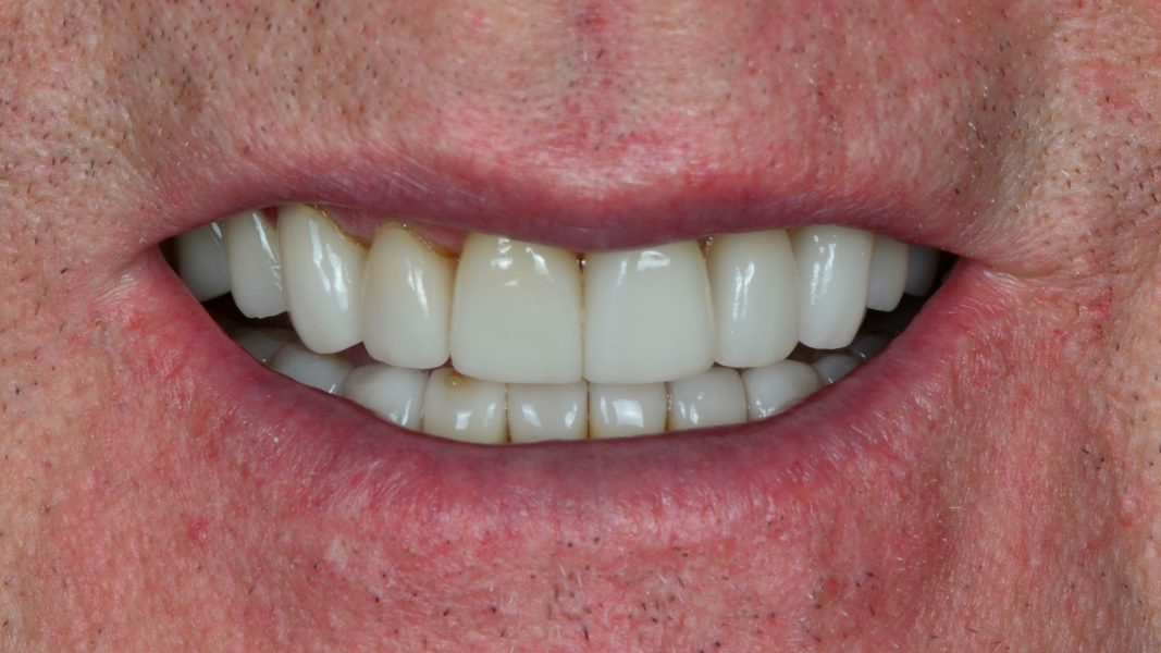 Close-up of a smiling mouth showing white teeth and pink lips