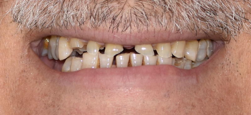 Close-up of a person’s mouth showing several missing and damaged teeth with discoloration