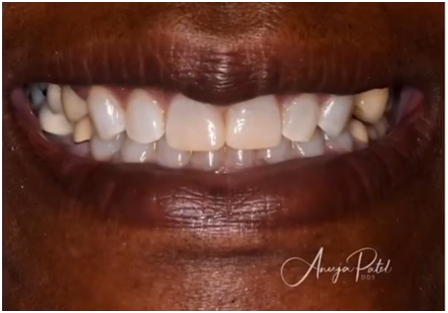 Close-up of a smiling mouth showing white teeth and dark brown lips.