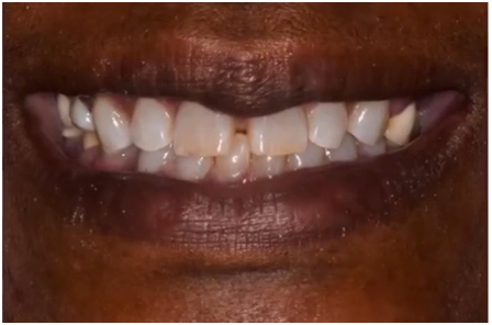 Close-up of a smiling mouth with visible teeth and dark lipstick