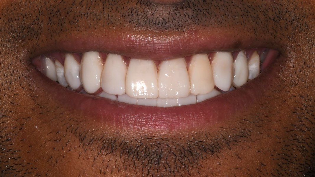 Close-up of a smiling mouth showing white teeth and pink lips