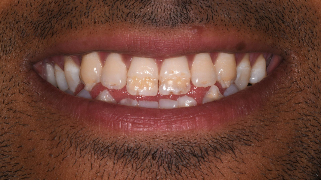 Close-up of a smiling mouth with visible teeth and lips