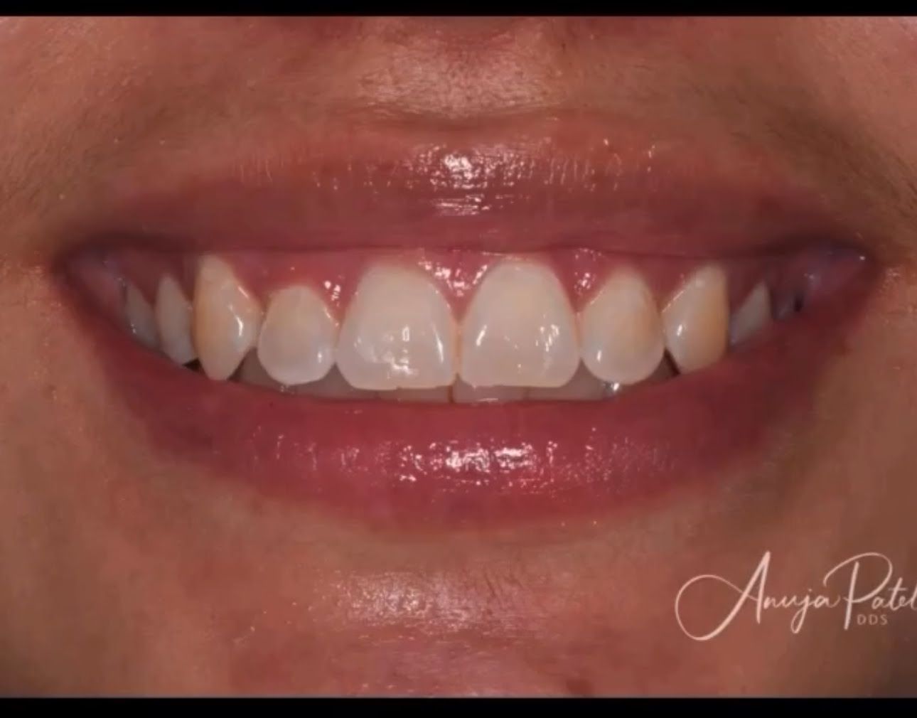 Close-up of a smiling mouth showing bright white upper teeth and pink lips