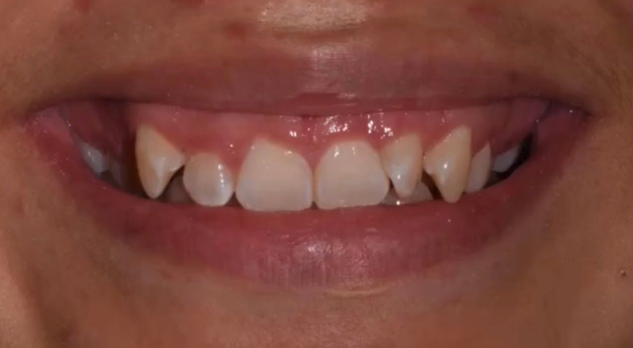Close-up of a smiling mouth with visible teeth and slight crookedness