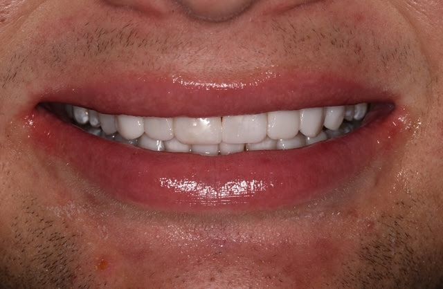 Close-up of a smiling mouth showing white teeth and pink lips